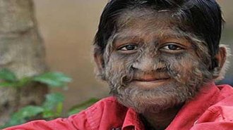 human werewolf syndrome