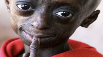 progeria